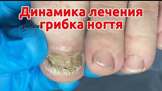 Ушиб ногтя – признаки, виды, методы лечения, осложнения и риски, профилактика