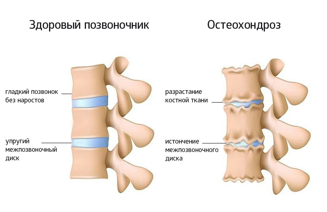 Остеохондроз на картинке