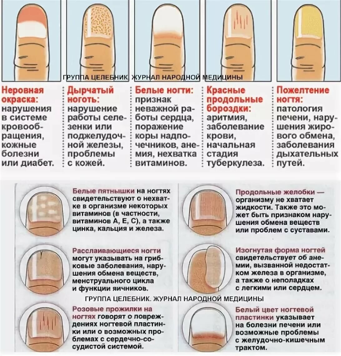 Выявление болезни по ногтям