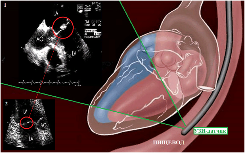 Эхо сердца что это такое. Чреспищеводная эхокардиография. Чреспищеводная эхокардиография показания. ЧП-Эхо-кг исследование что это. Трансэзофагеальная эхокардиография.