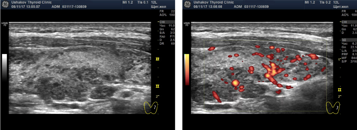 Могут ли узлы щитовидной железы рассосаться. Ультразвуковая анатомия щитовидной железы. Узел в щитовидной железе на УЗИ. Губчатый узел щитовидной железы.