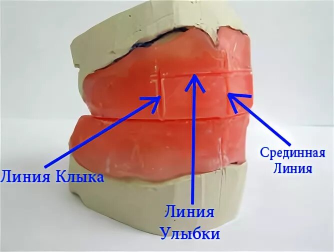 Изготовление воскового базиса с окклюзионными валиками презентация