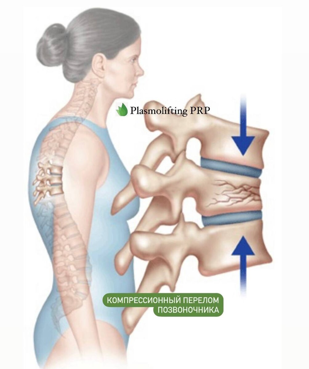 Лечение последствия компрессионного перелома позвоночника