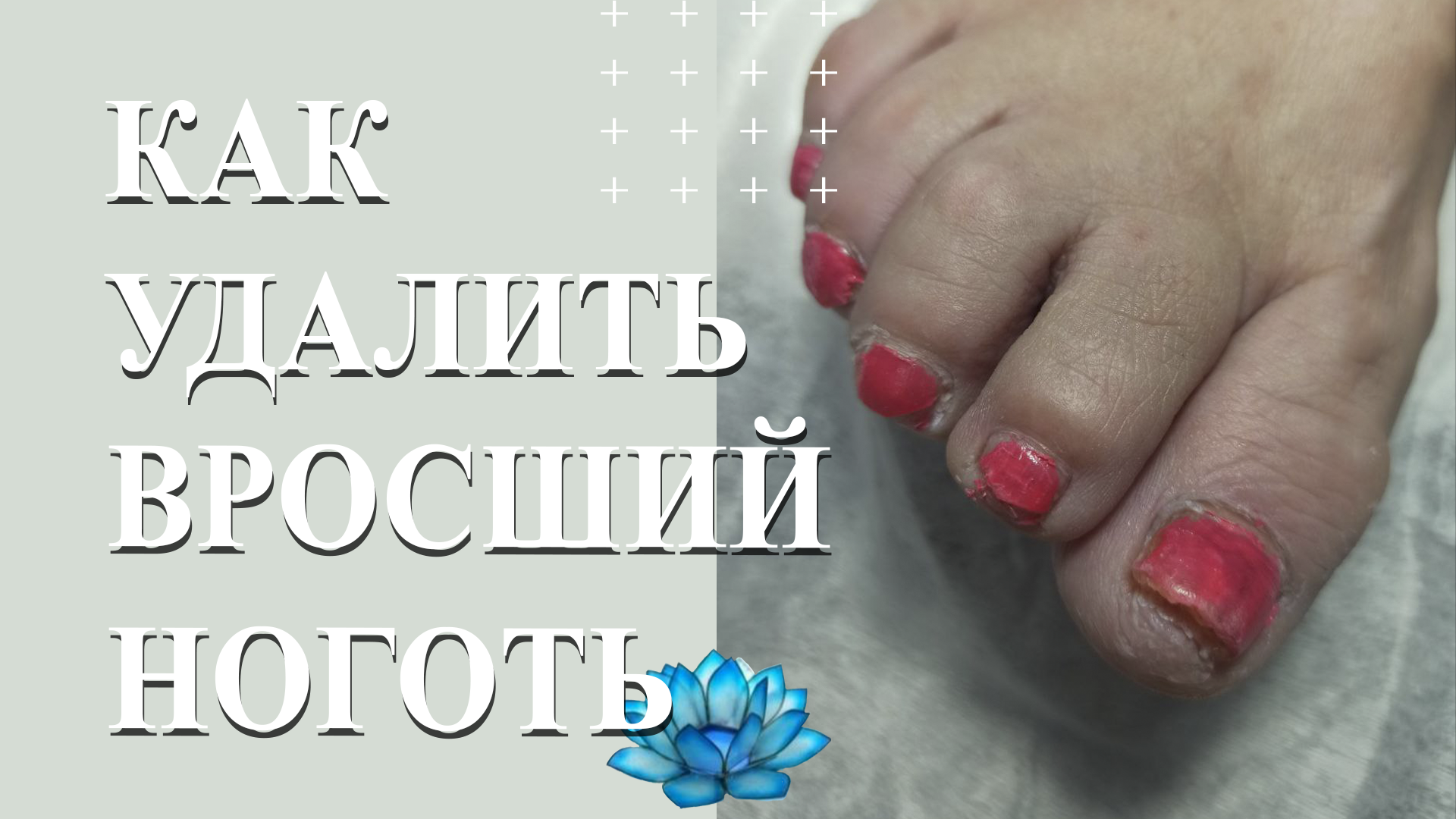 Лечение вросшего ногтя в Хабаровске: цены от рублей