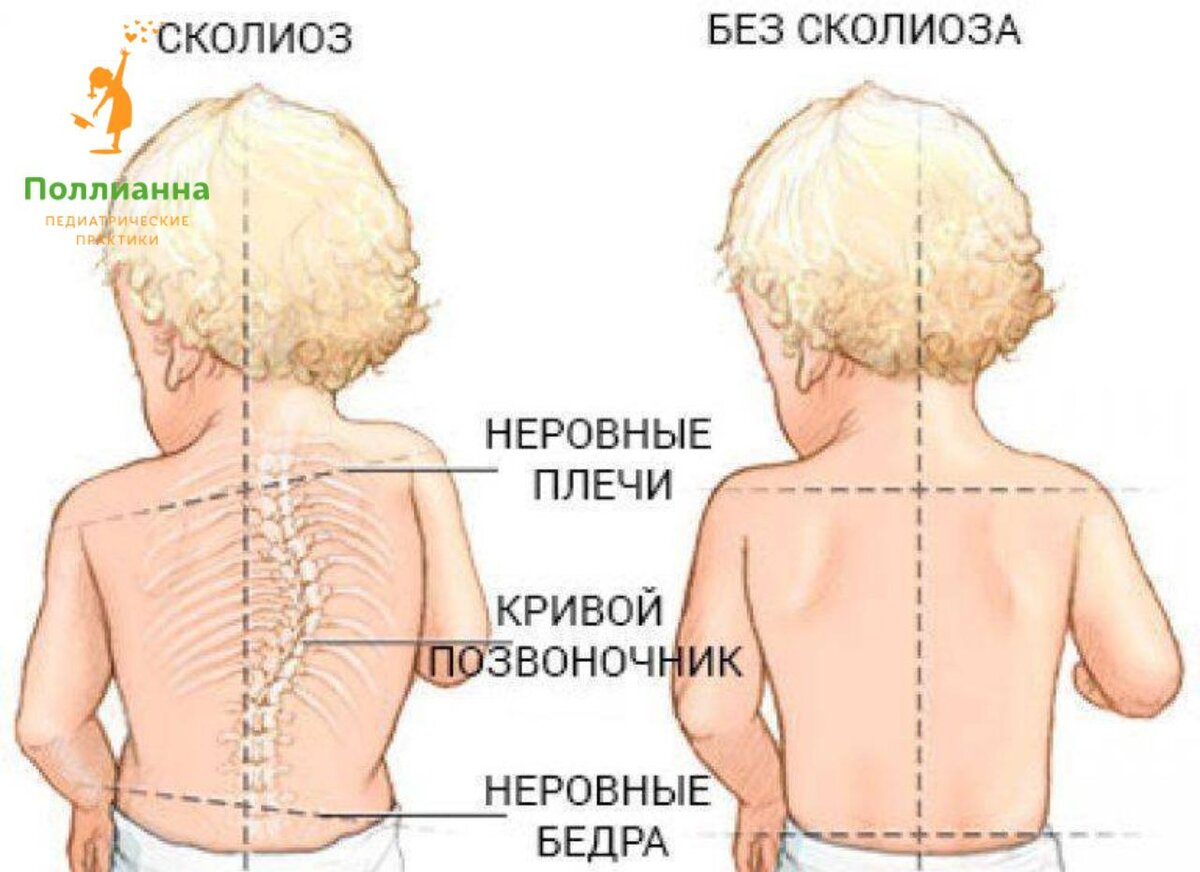 Сколиоз, искривление позвоночника