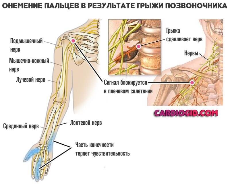 Боли в сердце немеет левая рука. Мышечно кожный нерв. Топография плечевого сплетения. Поражение мышечно кожного нерва.