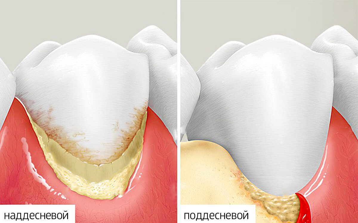 Как убрать зубную. Зубной камень наддесневые отложения. Наддесневой и поддесневой зубной камень. Поддесневой зубной камень состав. Наддесневой зубной камень образуется.