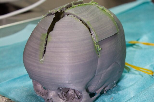    Такие 3D-модели изготавливают для каждого маленького пациента и по ним планируют ход операции. Фото:  Федеральный центр нейрохирургии (г.Тюмень)/ Наталья Тимофеева