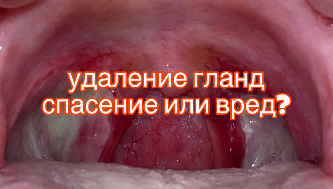удаление гланд "миндалин" операция тонзиллэктомия