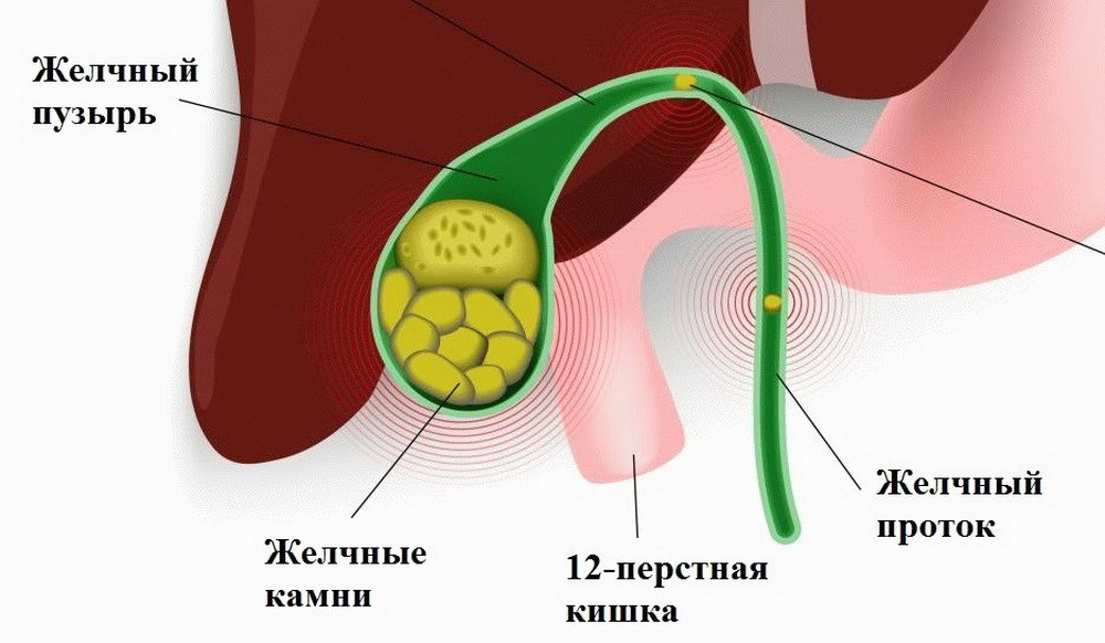 Взвесь в желчном. Желчный пузырь. Удаленный желчный пузырь.