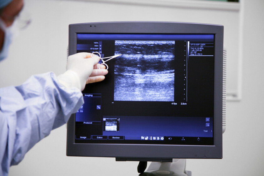 Ятрогенные повреждения сосудисто-нервного пучка и лимфатических коллекторов бедренного треугольника при флебэктомии