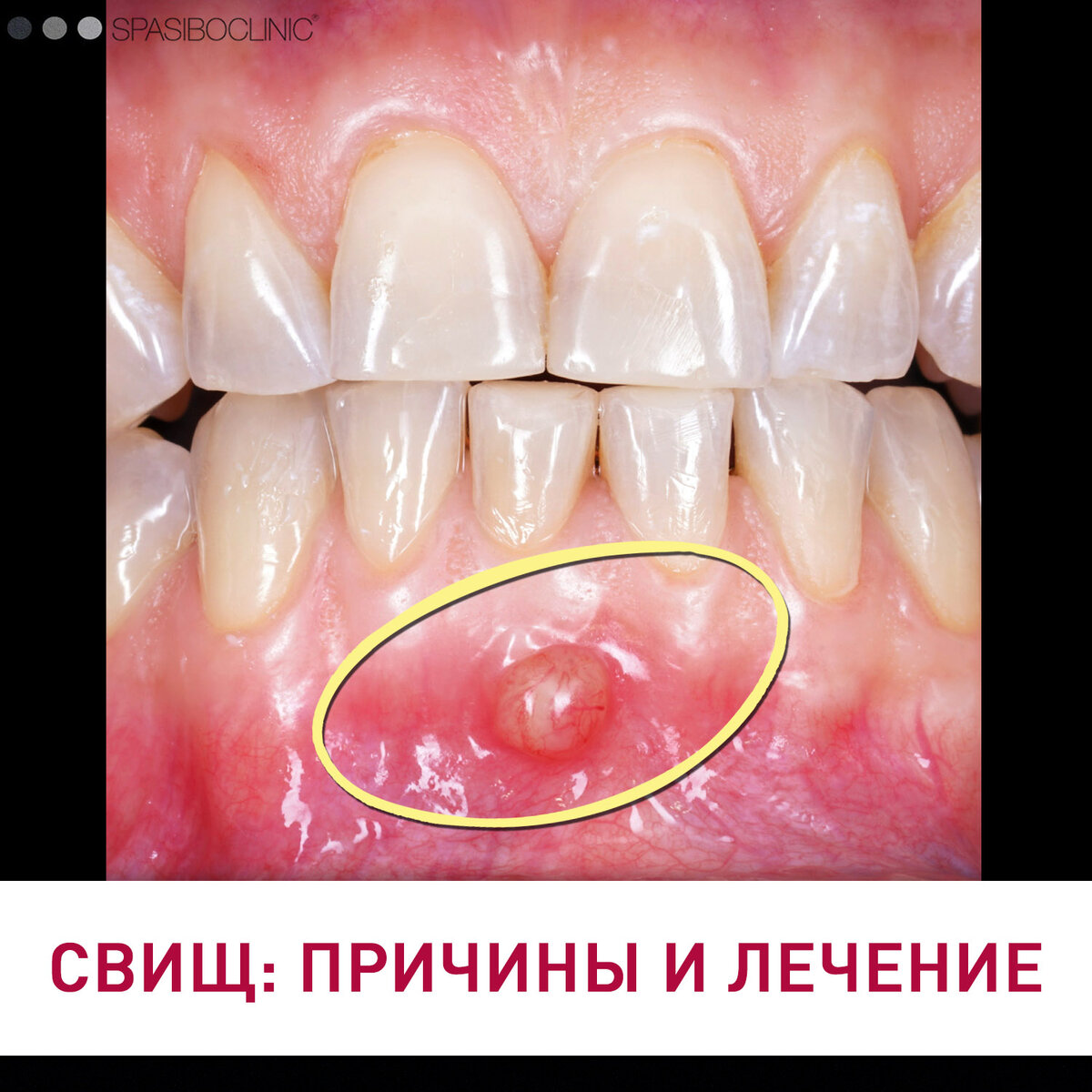 Даже под микроскопом сложно было обнаружить скрытый канал!⬆️  Природа бесконечно разнообразна🤓 

⚙️Терапия — Ксения Резникова @dr_reznikovaksenya НЕОБХОДИМА КОНСУЛЬТАЦИЯ СПЕЦИАЛИСТА🤓  