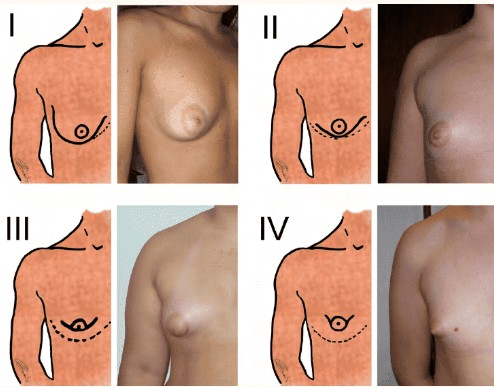 Тубулярная грудь и ее коррекция: как все сделать правильно
