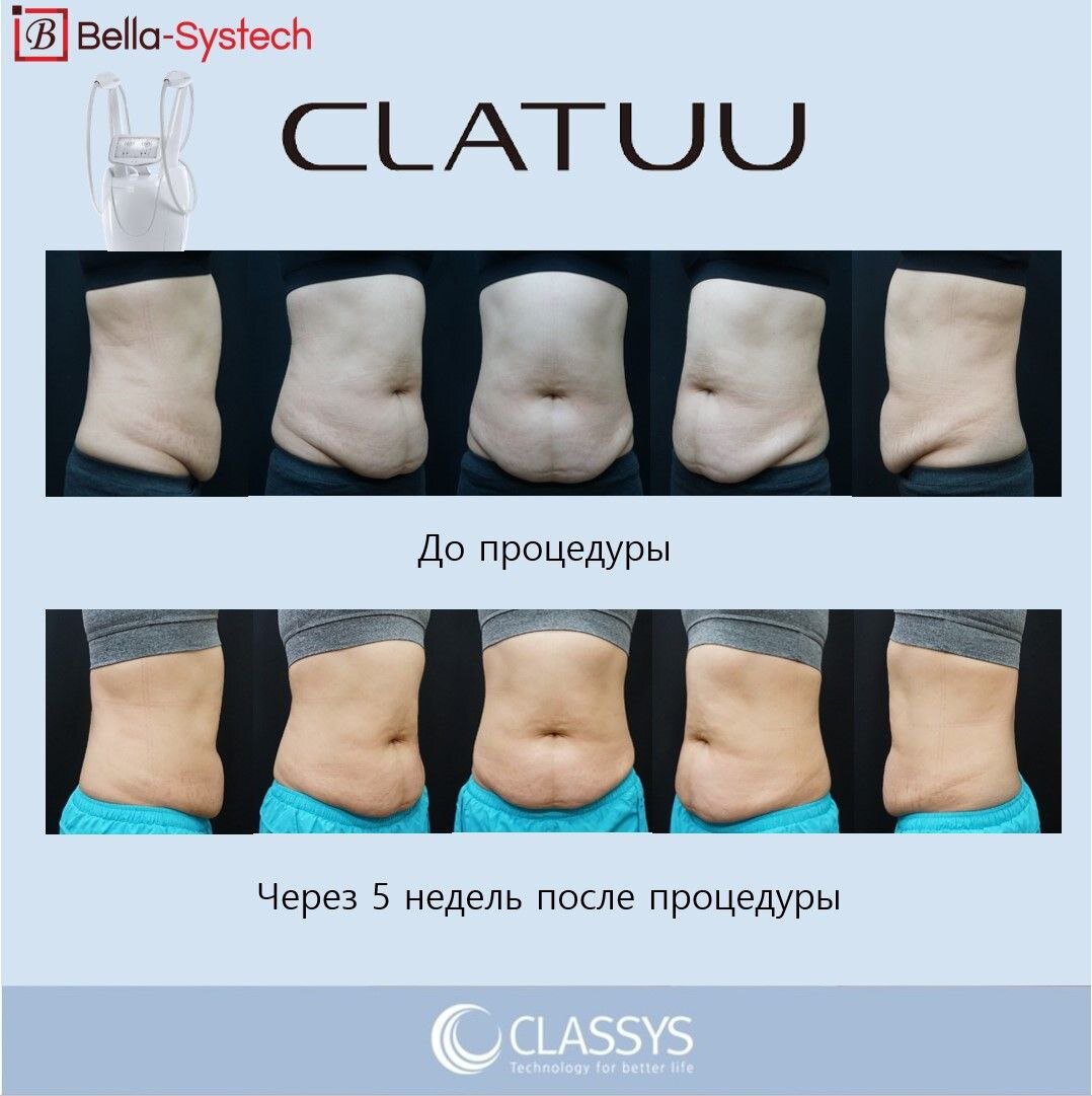 Подробнее про аппарат: https://bellasystech.ru/catalog/equipment/clatuu/