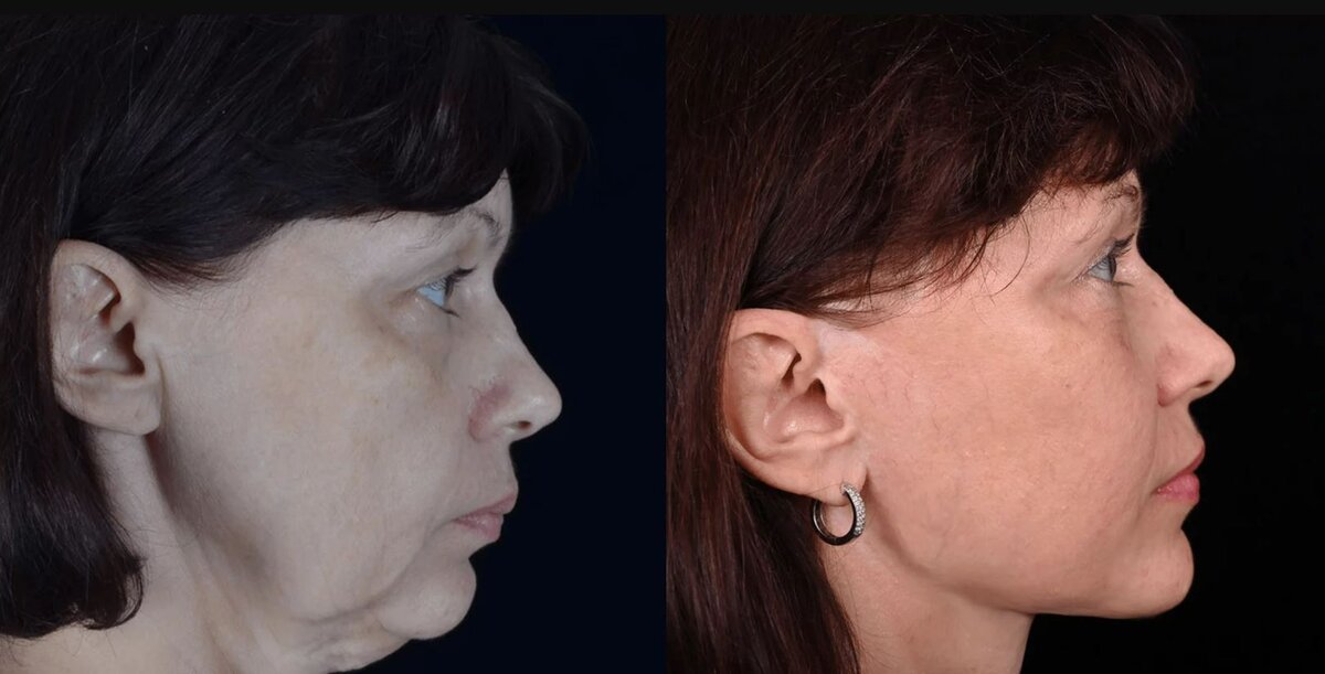 Подтяжка SMAS-лифтинг с укороченным рубцом фото до и после. Фото с сайта Д.Р. Гришкяна. Имеются противопоказания, требуется консультация специалиста