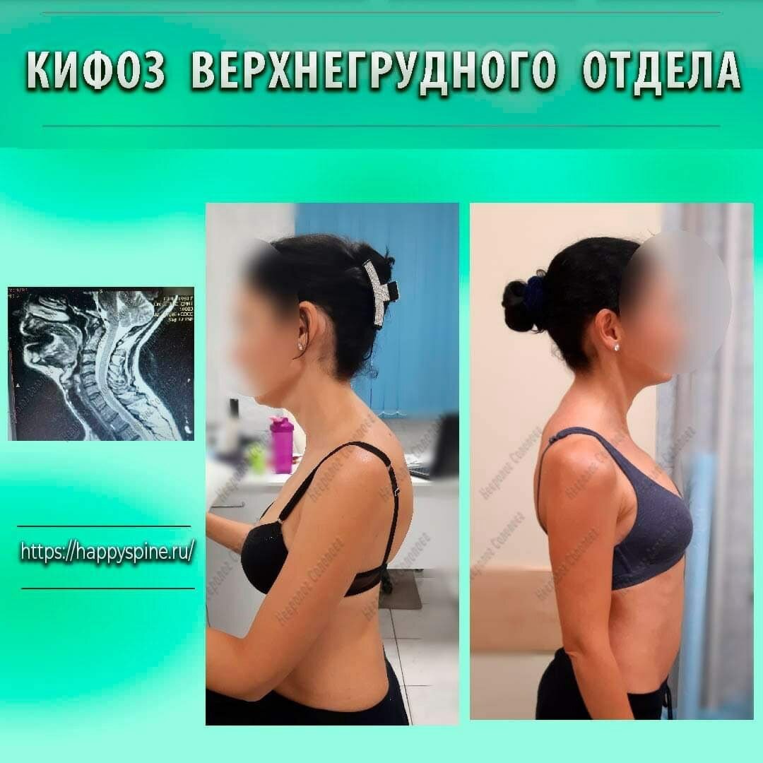 Кифоз верхнегрудного отдела