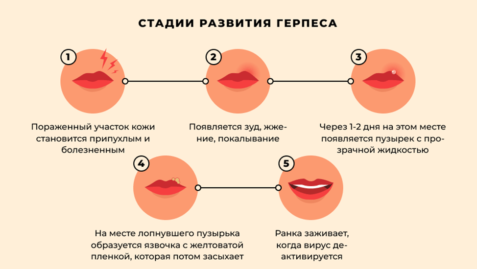 Как выглядит герпес внутри Через сколько проходит герпес при лечении найдено 89 картинок