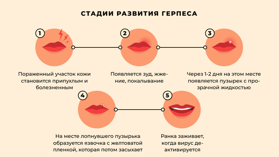 Герпес на губах что эффективно. Герпес стадии протекания. Стадии появления герпеса. Стадии развития герпеса на губах. Стадии появления герпеса на губах.