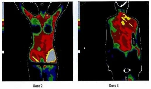 Обратите внимание на чёрные пятна (грудь и ягодицы) и жёлтые полосы - слепая кишка, яичники, сигмовидная...