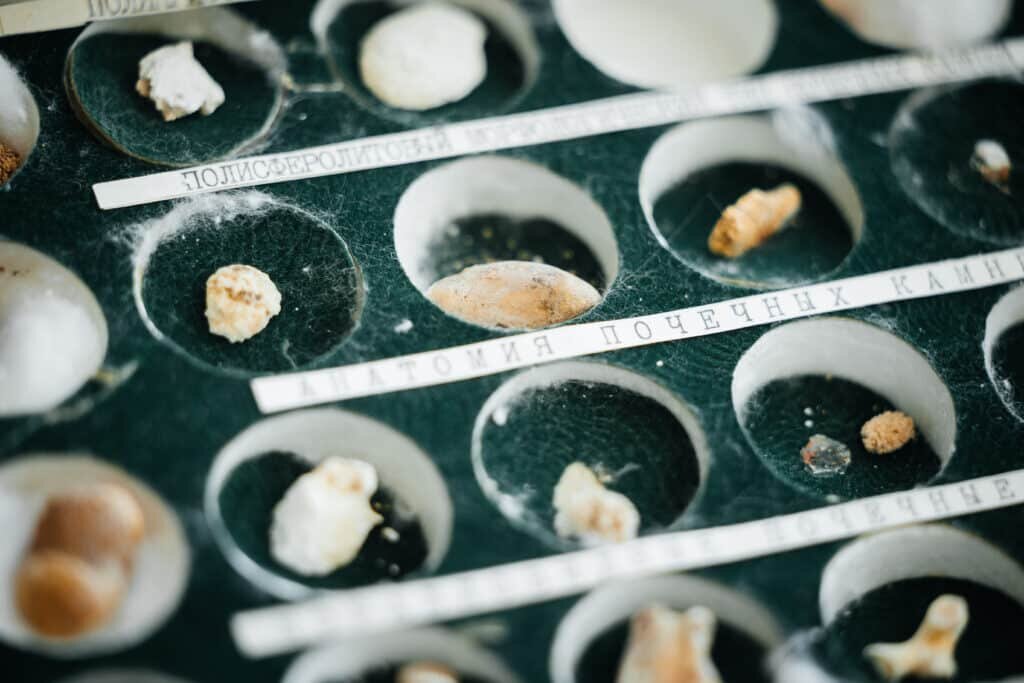    Уролиты / ©Пресс-служба ТПУ