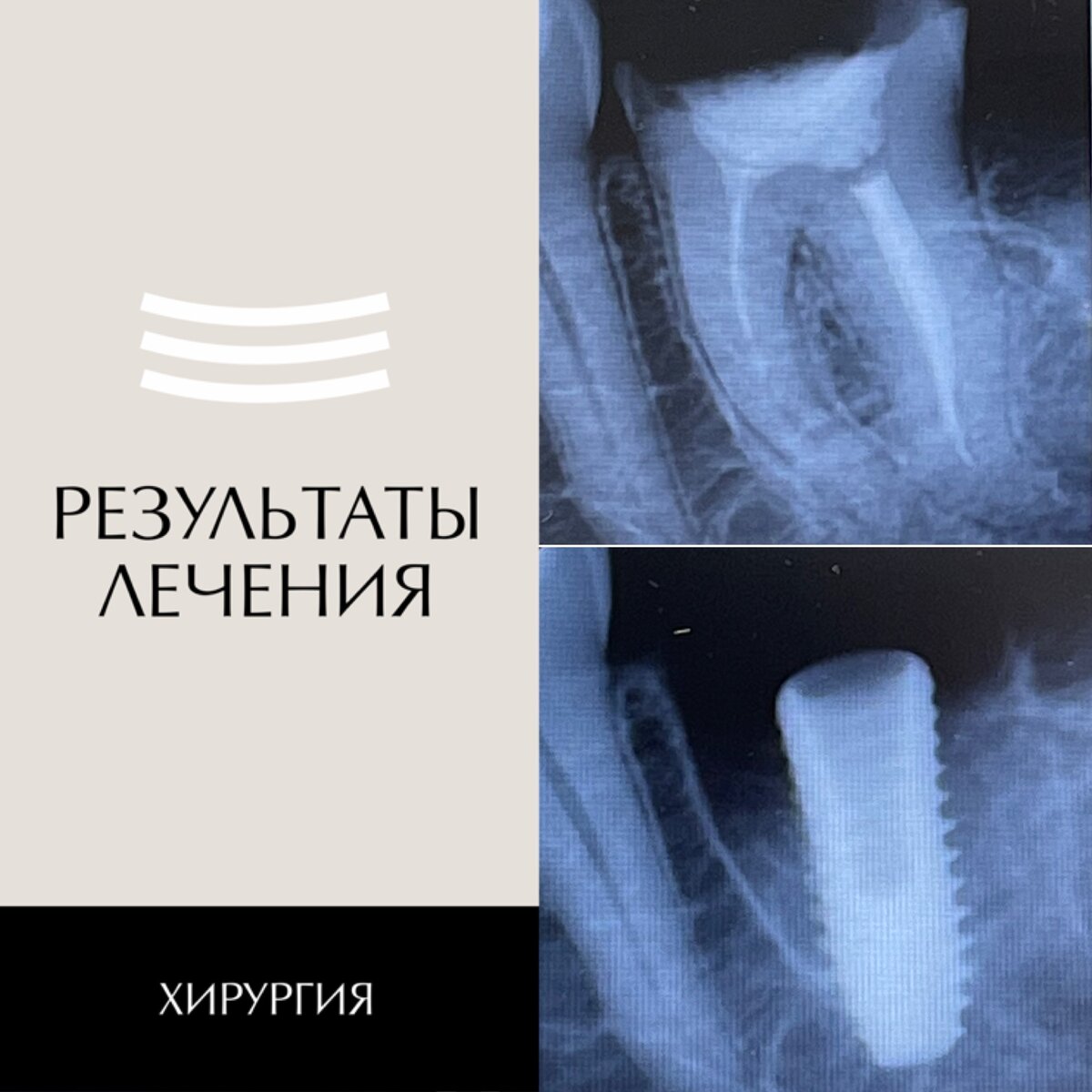 Результаты одномоментной имплантации 
