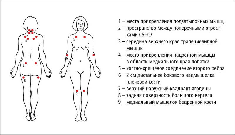Фибромиалгия болевые точки. Фибромиалгия триггерные точки схема. Болевые точки при фибромиалгии. -Фибромиалгия (боль в мышцах).