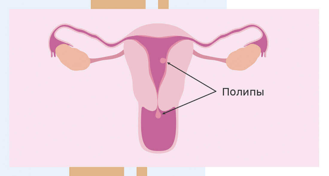 Полипы в матке