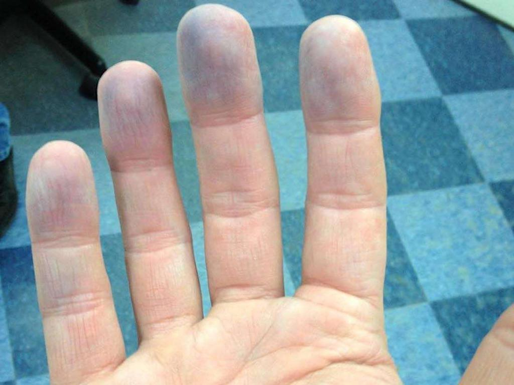 Почему палец назвали палец. Темные пятна на костяшках пальцев рук.