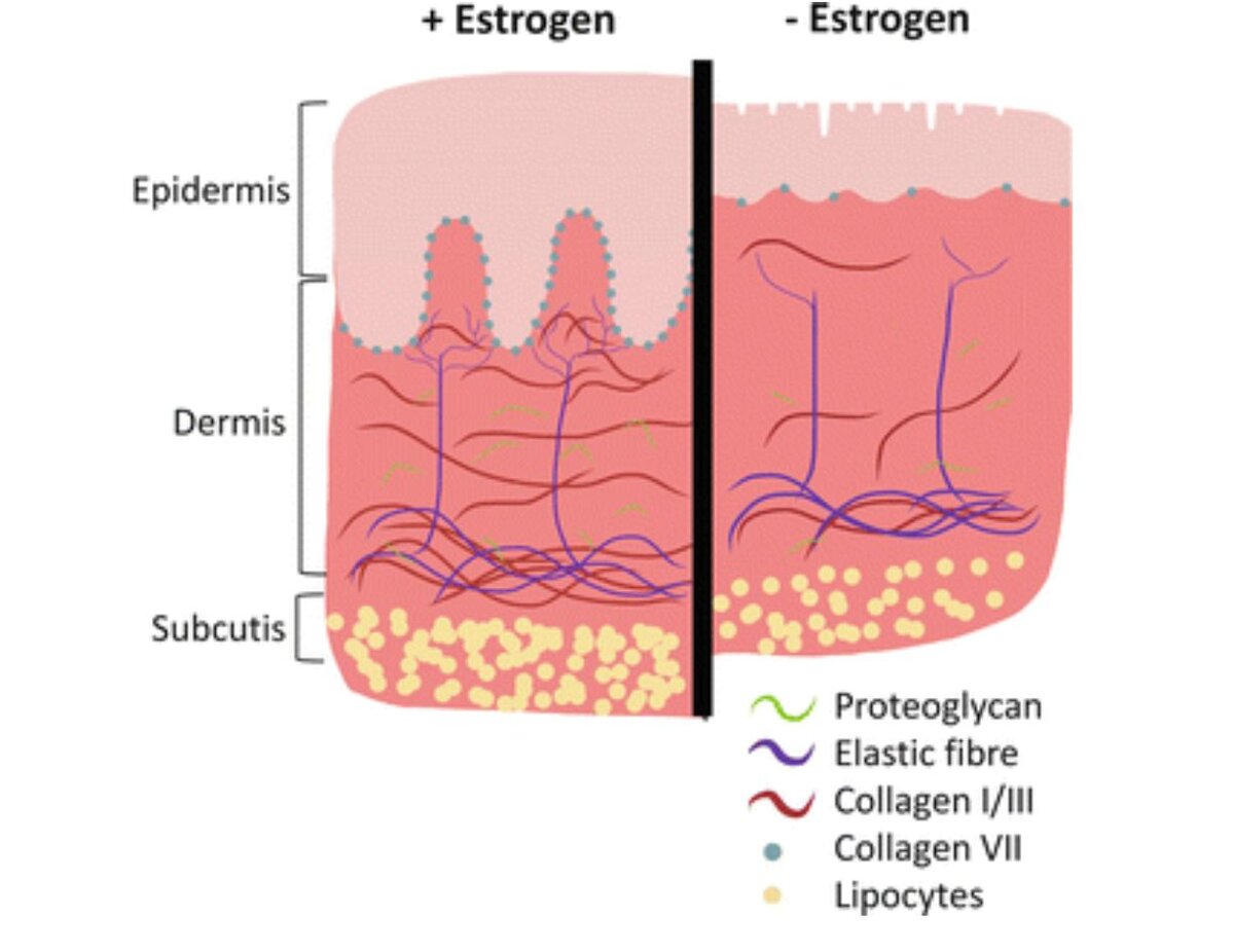 Кожа при снижении эстрогена (справа): тоньше, меньше волокон коллагена и эластина, менее жировой клетчатки (поэтому становится сухой), эпидермис с сеткой морщин 