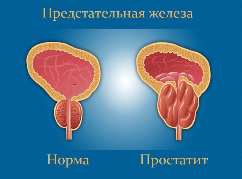 Слабый напор при мочеиспускании у мужчин, проблемы с мочеиспусканием: причины и лечение в Москве