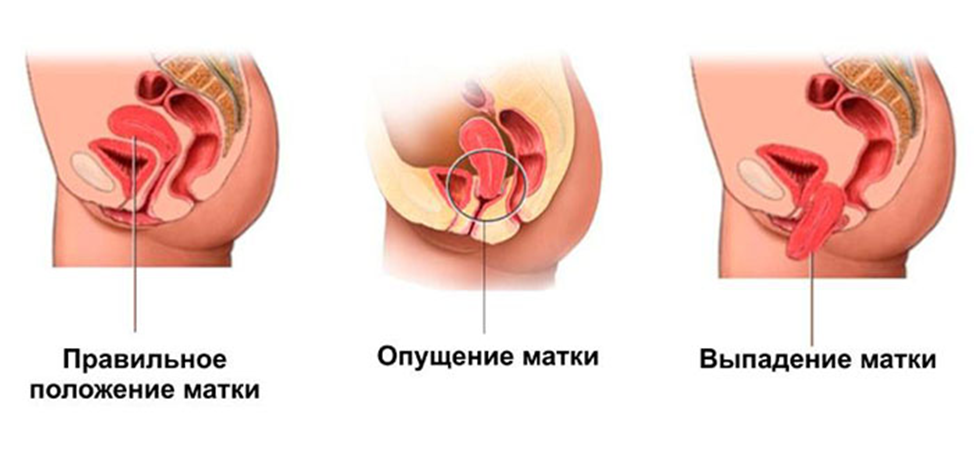 Гипертонус матки