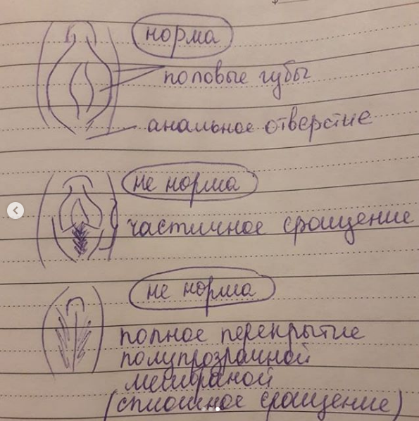 Схемы лечения синехий у девочек. Схемы лечения синехий у девочек. Внутриматочных синехий. Сращение половых органов у девочек. Сращение малых губ у ребенка.