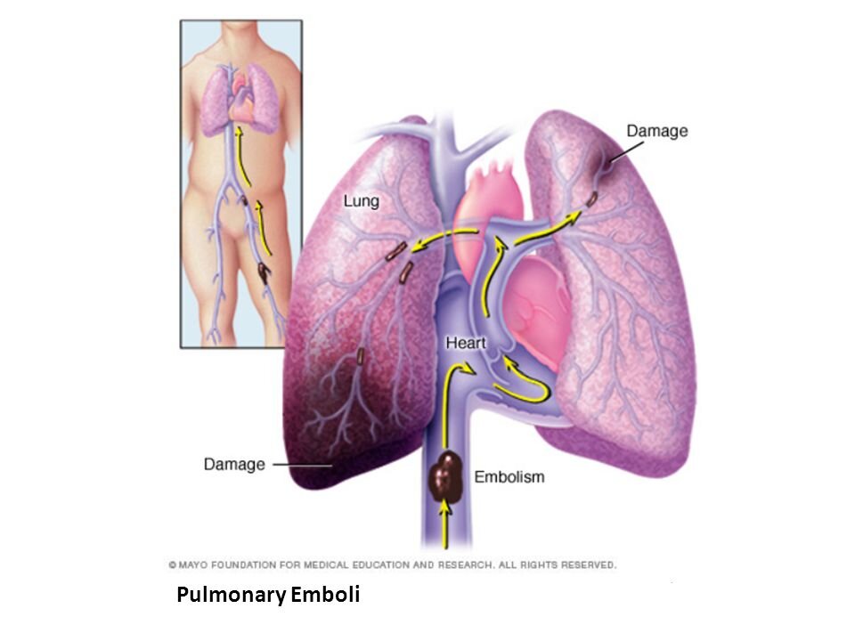 Легочная эмболия что. Осложнения тромбоэмболии легочной артерии. Тромбоэмболия сегментарных ветвей легочной артерии. Тромбоэмболия легочного ствола. Тромбоэмболия левой легочной артерии.