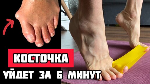 Как избавиться от косточки за 6 мин. Тренировка + Массаж. #косточка #тренировка #вальгуснаядеформация