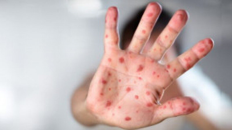     Корь. Фото: архив ФБУЗ «Центр гигиены и эпидемиологии в Алтайском крае»