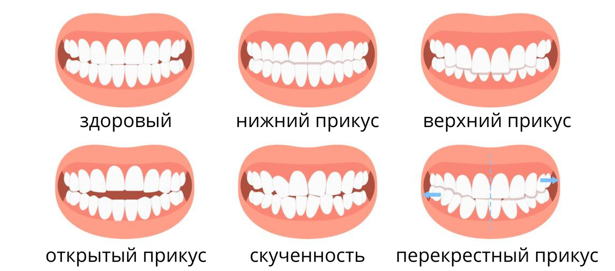 Неправильный прикус виды