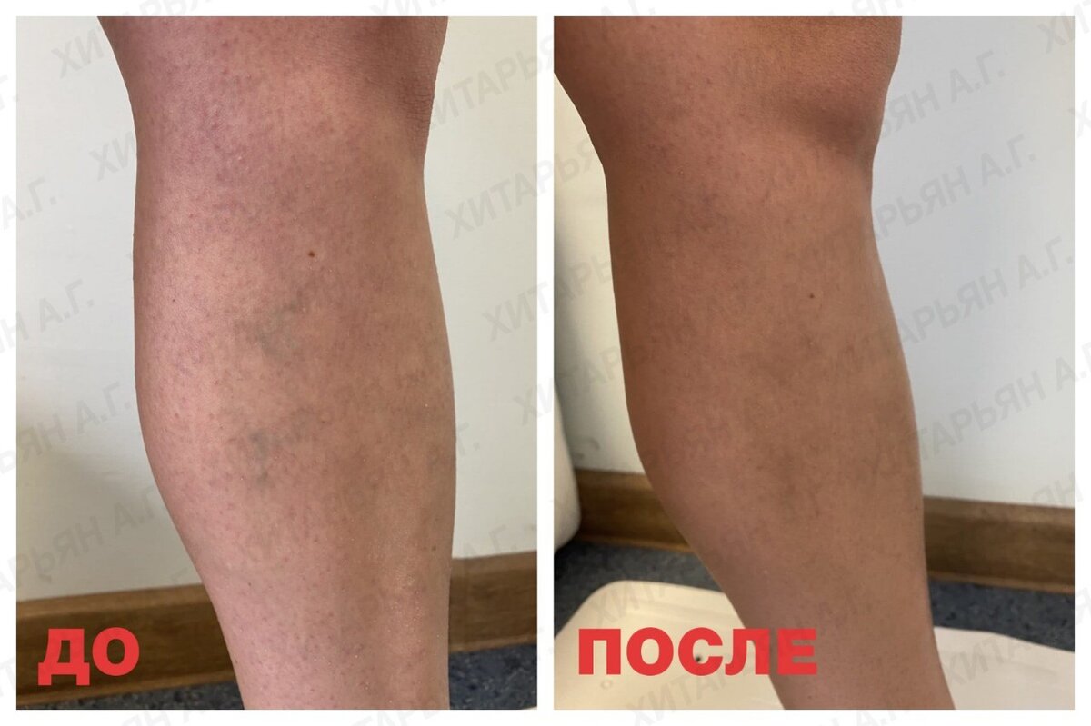 Результаты до и после лазерной коррекции