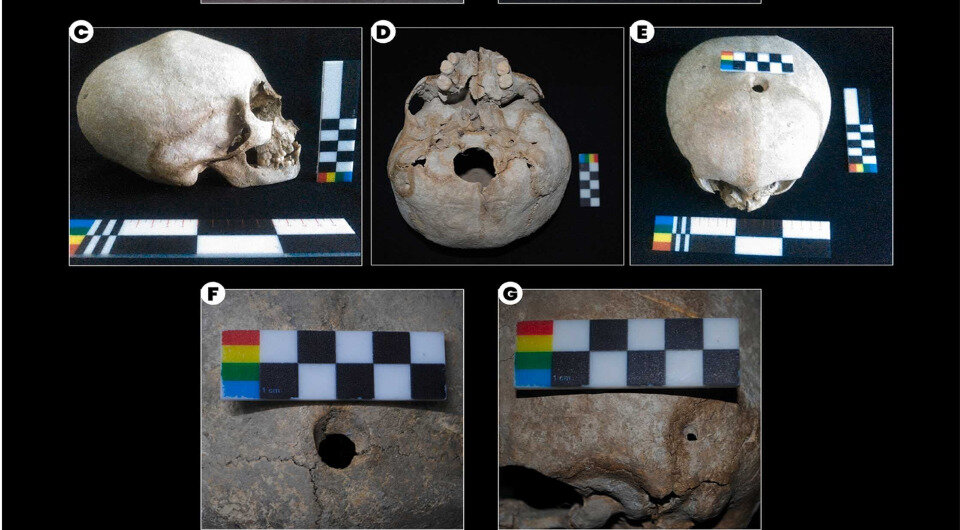   Claudia Rojas-Sepuleveda et al. / International Journal of Paleopathology, 2023