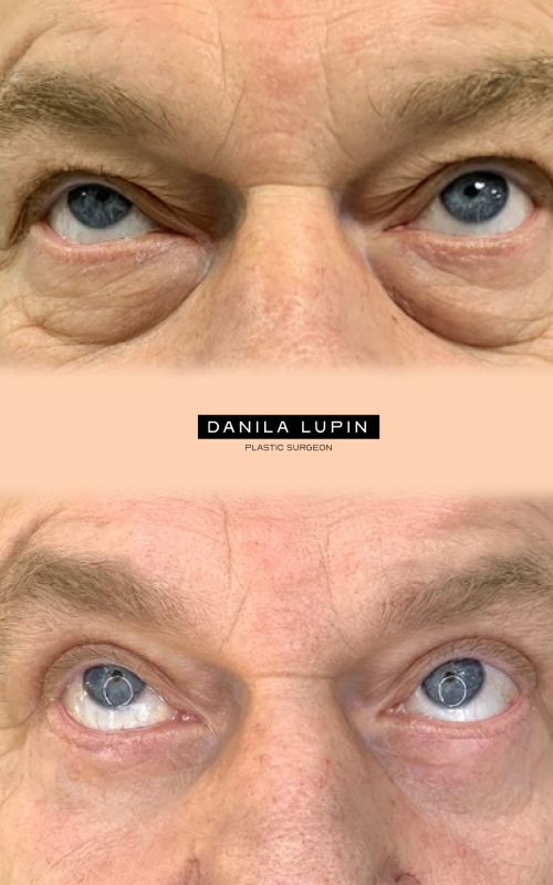 Топ?5 заблуждений о блефаропластике