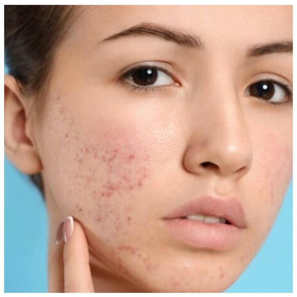    Акне