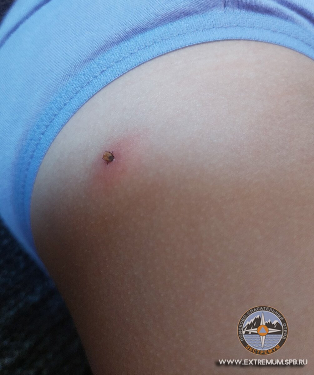Присосавшийся клещ на теле ребенка