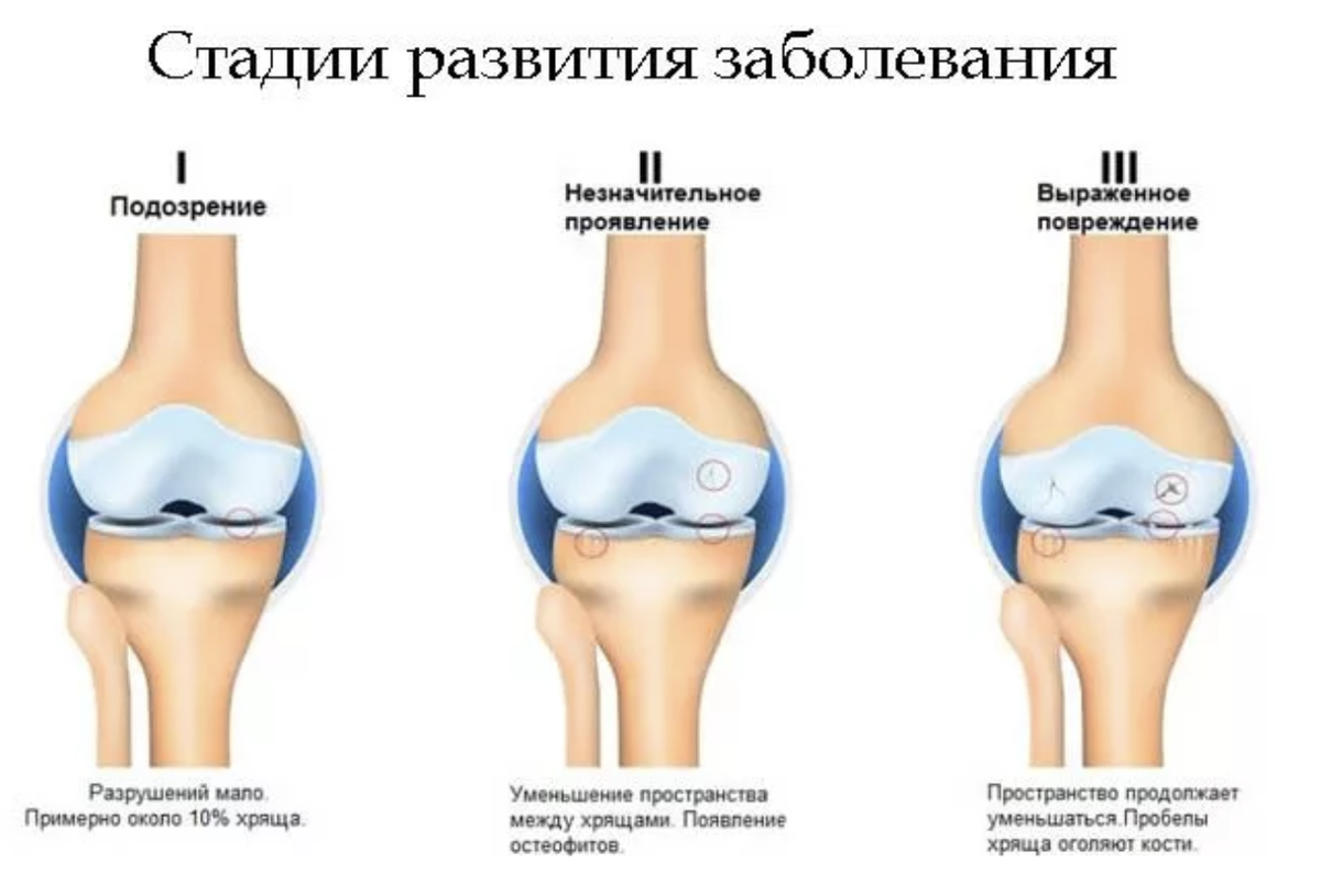 Остеоартроз 2 степени лечение. Деформирующий остеоартроз коленного сустава 1. Деформирующий остеоартроз коленного сустава степени. Деформирующий остеоартроз 1 стадия. Стадии деформирующего остеоартроза коленных суставов.