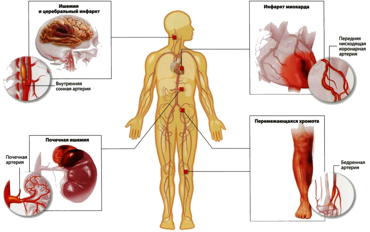 Мультифокальный атеросклероз. Органы мишени атеросклероза. Атеросклероз нижних конечностей мкб. Органы мишени при атеросклерозе. Атеросклероз коронарных и церебральных артерий.
