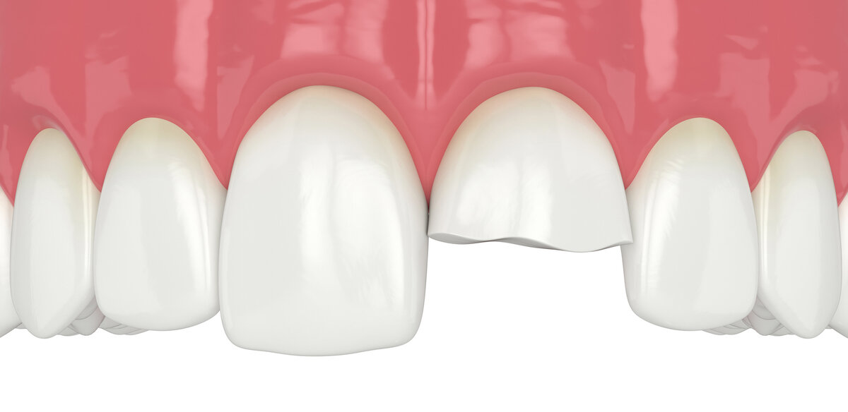 Сломался зуб под корень (под десну) полностью или наполовину: цена лечения в Москве