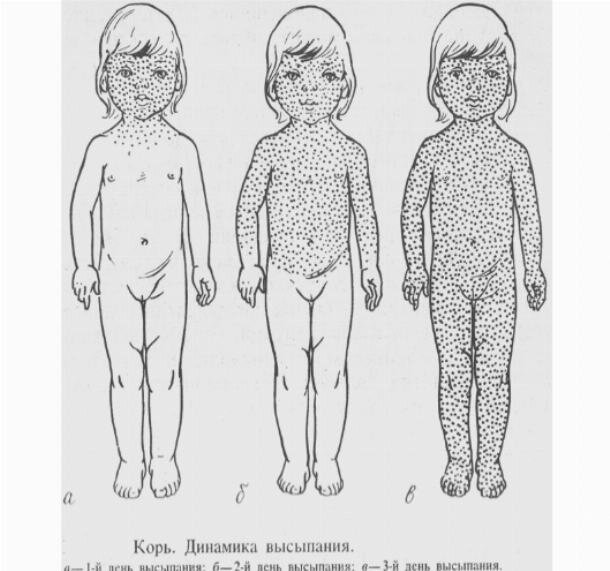 Какая сыпь при краснухе у детей фото Корь: чем опасна и как спастись? Педиатрия с Павловым-просто о сложном и немного