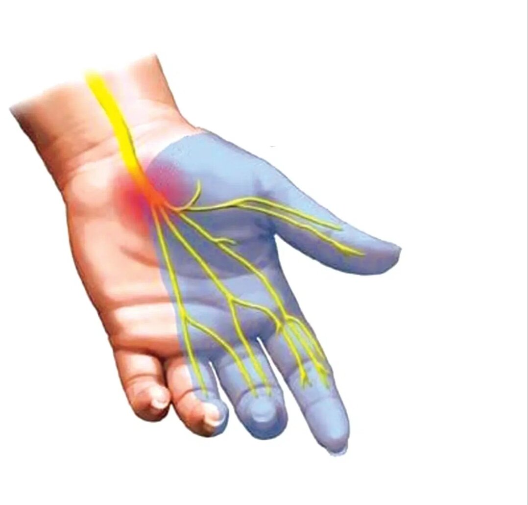 Нейропатия срединного нерва на руке