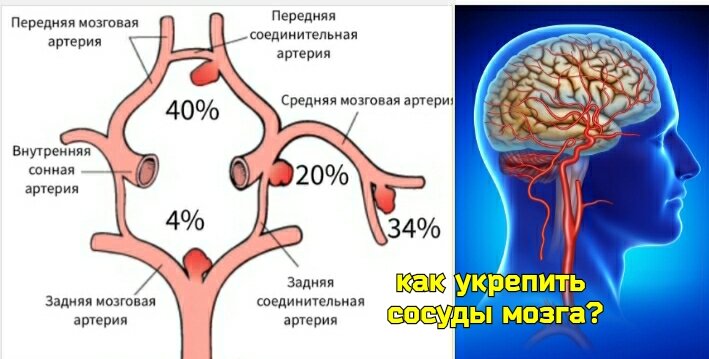 Виды стеноза сосудов головного мозга