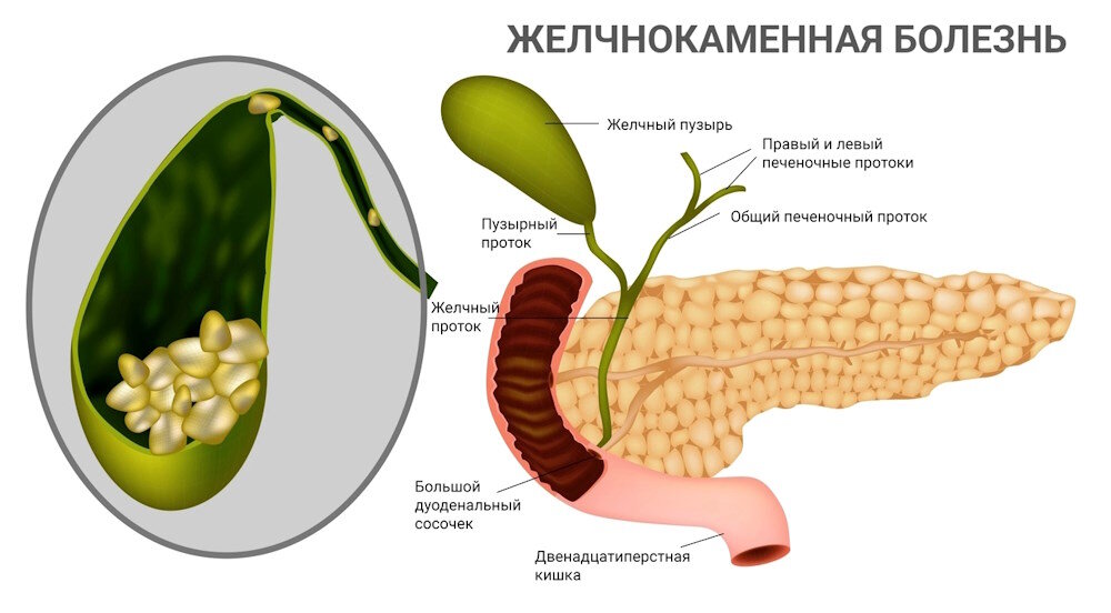 Причины камней в желчном пузыре