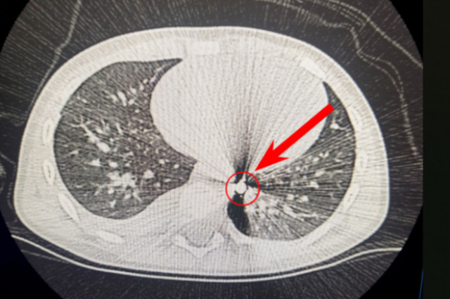    Пуля прошла рядом с сердцем. Фото: Ивано-Матренинская детская больница Иркутск