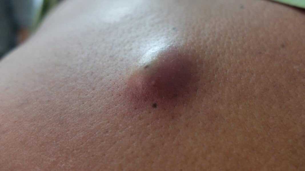 Атерома спины. Фото из открытых источников.